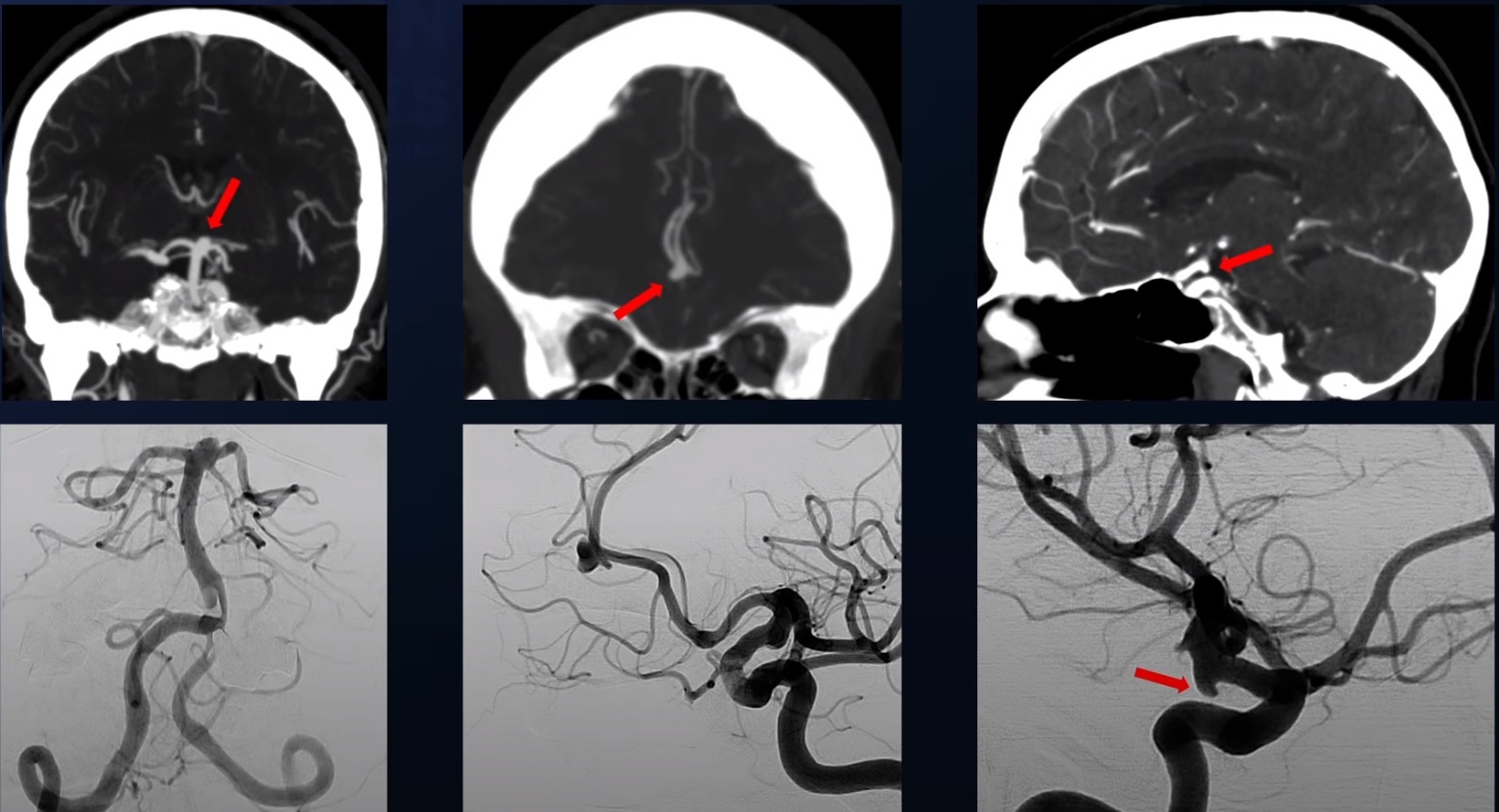 What Is Cerebral Aneurysm Symptoms Diagnosis And Treatments