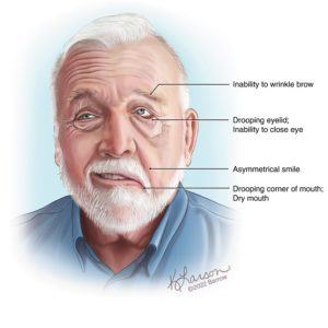 Facial Palsy Barrow Neurological Institute