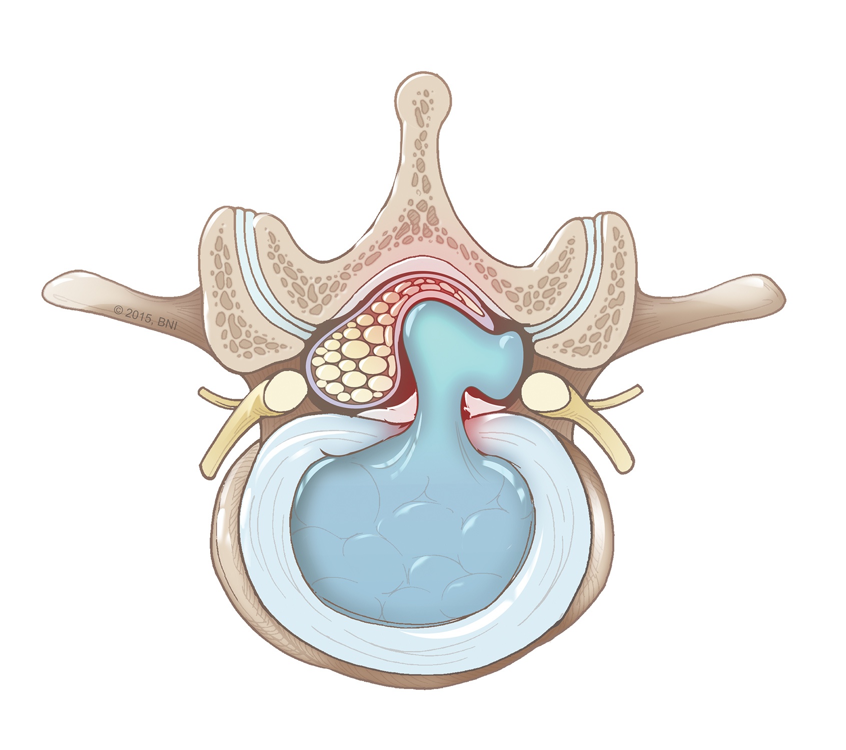 What Is A Disc Herniation Barrow Neurological Institute