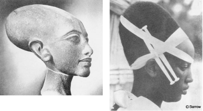 Cranial Asymmetry