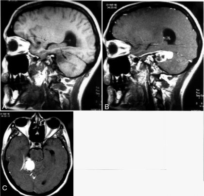 Hemangioblastoma with a 