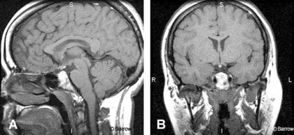 Imaging of the Pituitary Gland | Barrow