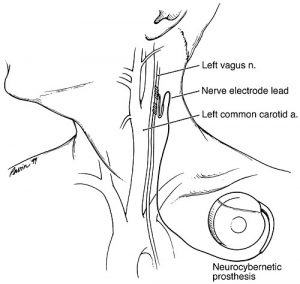 vagal nerve stimulator