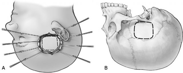 The Middle Fossa Approach Barrow 