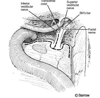 decompression internal auditory canal