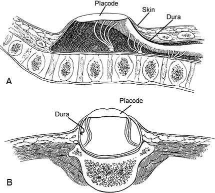 Myelomeningocele Repair Barrow Neurological Institute