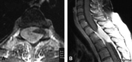 Epidural and Transforaminal Spinal Meningiomas | Barrow