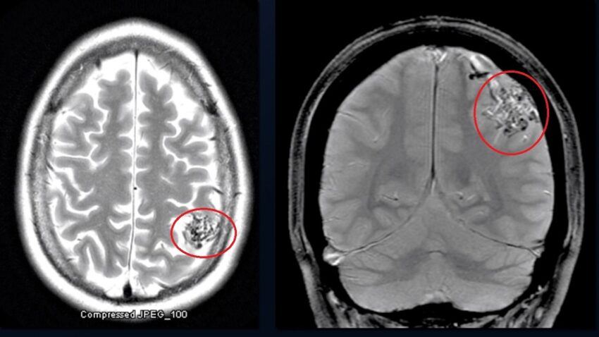 Brain Arteriovenous Malformation (AVM) - Diagnosis and Treatment