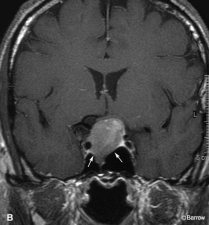 Double Sellar Floor: Radiographic Sign for a Pituitary Adenoma | Barrow