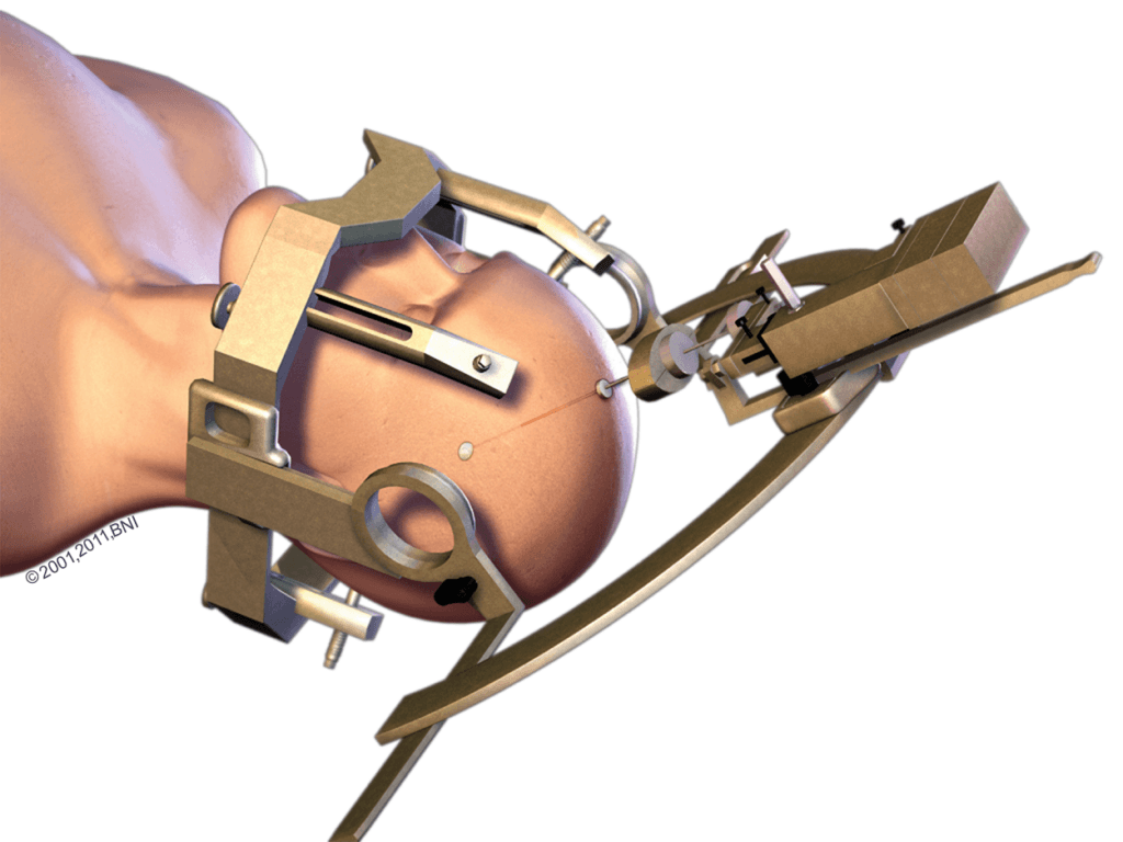 illustration of the stereotactic frame used to precisely place deep brain stimulation leads during surgery to treat epilepsy, essential tremor, dystonia, parkinson's disease, and major depression