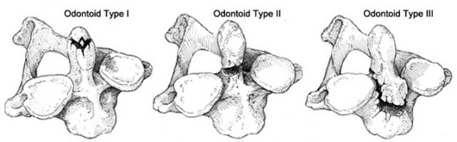 comminuted odontoid fracture type 1