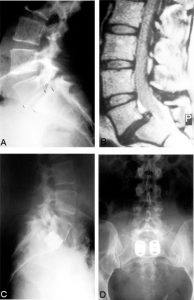 Internal Fixation and Fusion of the Lumbar Spine Using Threaded Interbody Cages Figure 12