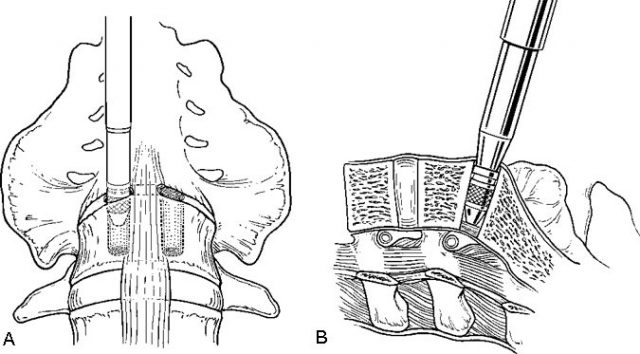 The Laparoscopic Approach for Instrumentation and Fusion of the Lumbar ...