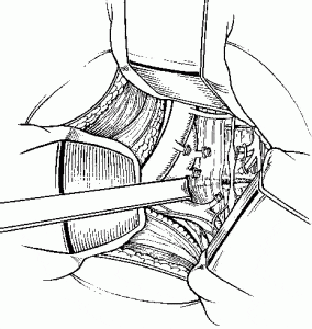 Internal Fixation and Fusion of the Lumbar Spine Using Threaded Interbody Cages Figure 23