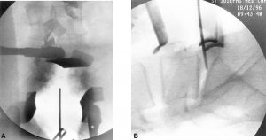 Internal Fixation and Fusion of the Lumbar Spine Using Threaded Interbody Cages Figure 24