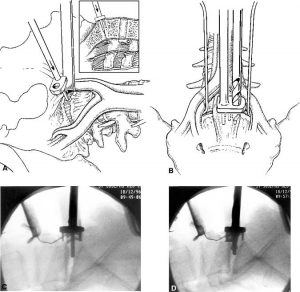 Internal Fixation and Fusion of the Lumbar Spine Using Threaded Interbody Cages Figure 25