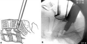 Internal Fixation and Fusion of the Lumbar Spine Using Threaded Interbody Cages Figure 27