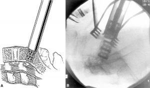 Internal Fixation and Fusion of the Lumbar Spine Using Threaded Interbody Cages Figure 31