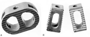 Internal Fixation and Fusion of the Lumbar Spine Using Threaded Interbody Cages Figure 5