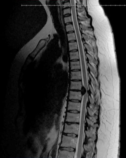 What is Minimally Invasive Lateral Thoracic Discectomy? | Barrow ...