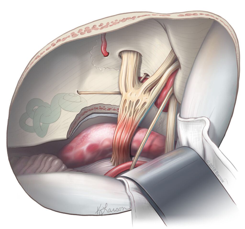 View of dolichoectatic basilar artery compressing trigeminal nerve root after the bone of the petrous apex within Kawase's triangle has been drilled.