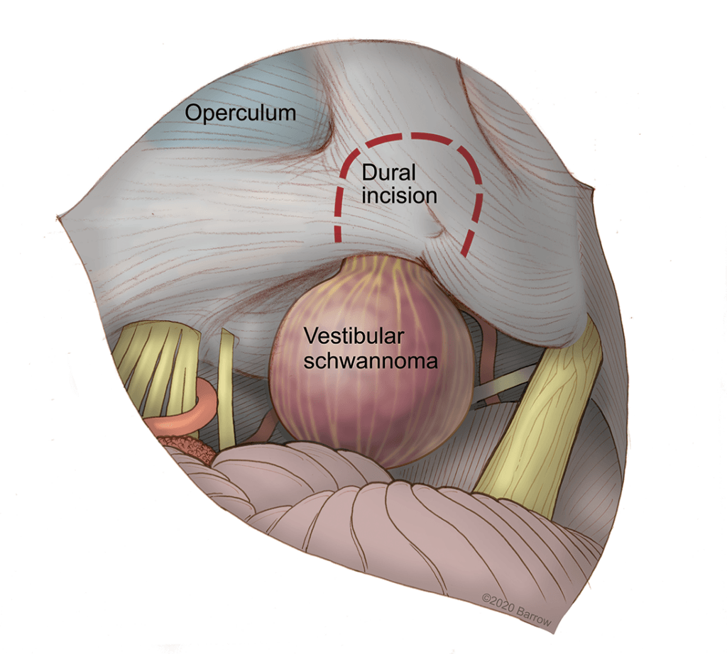 illustration showing a vestibular schwannoma