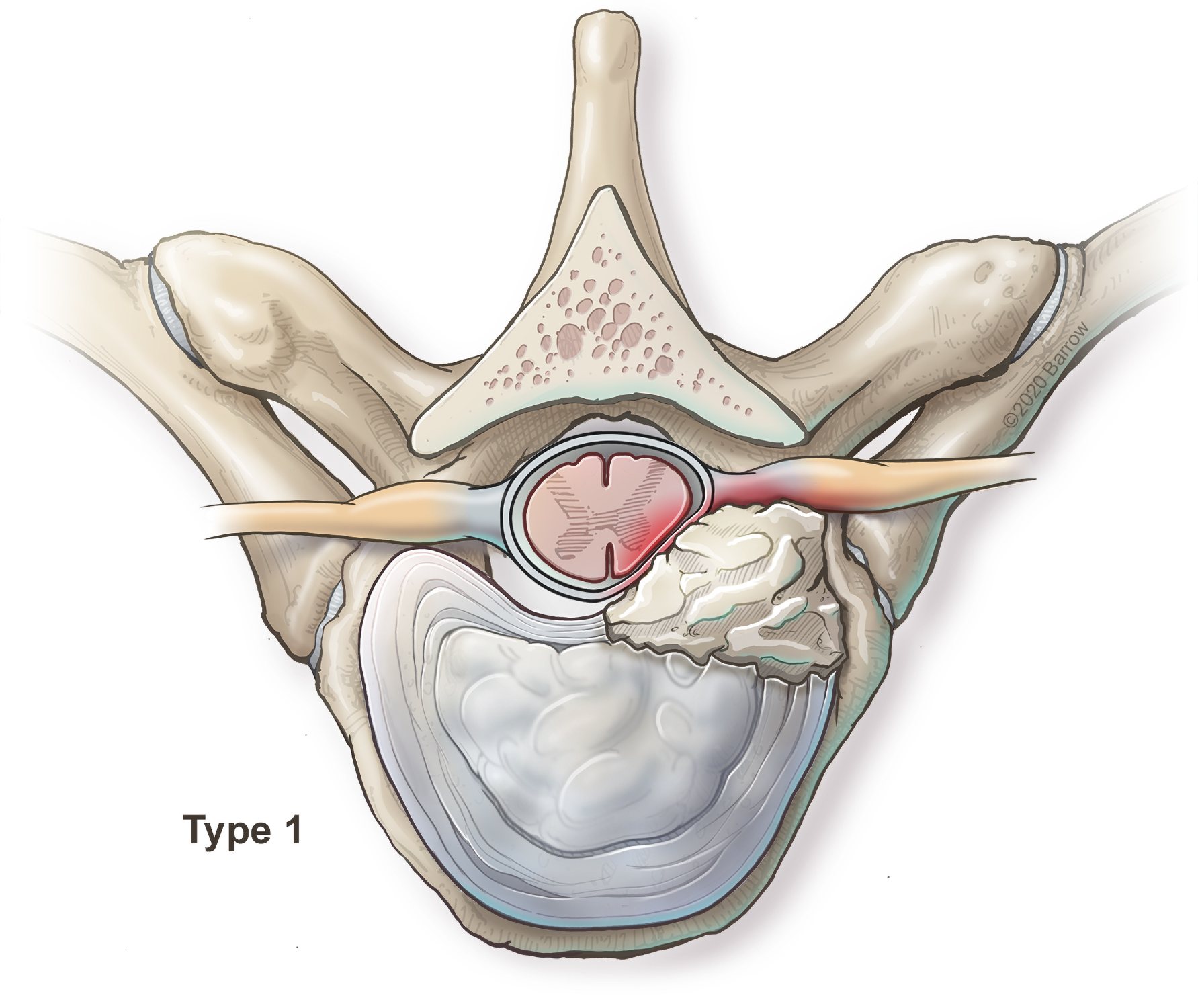 Herniated Disc (Ruptured or Slipped Spinal Disc)