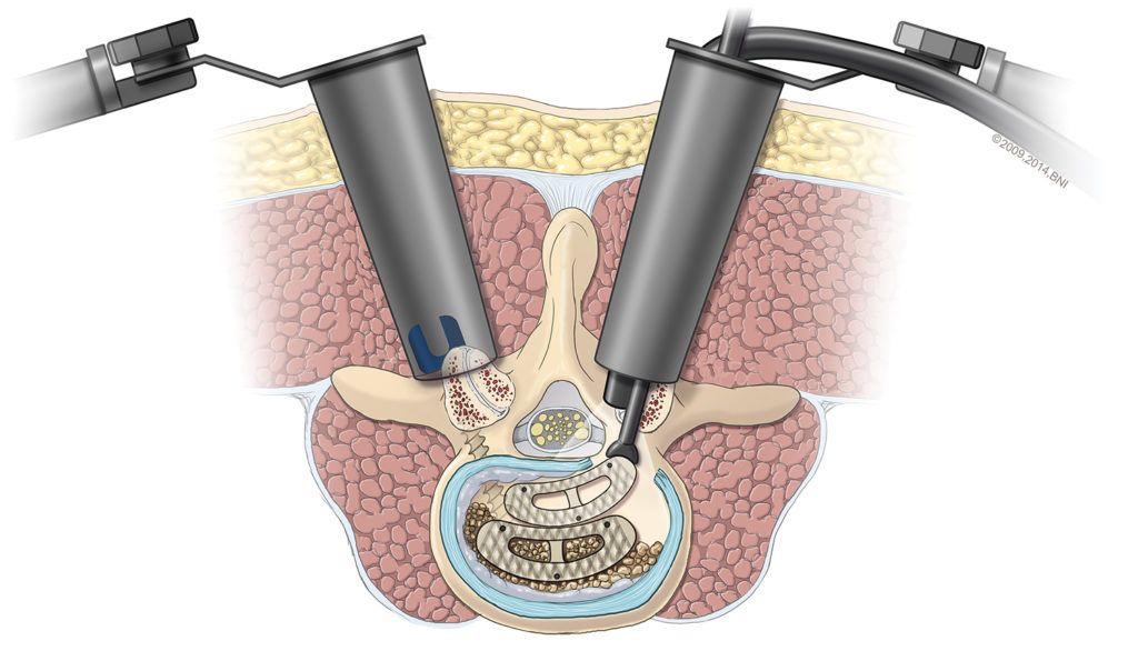 illustration showing transforaminal lumbar interbody fusion